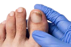 Nail Hygiene Fungal nail infections, conceal + treat